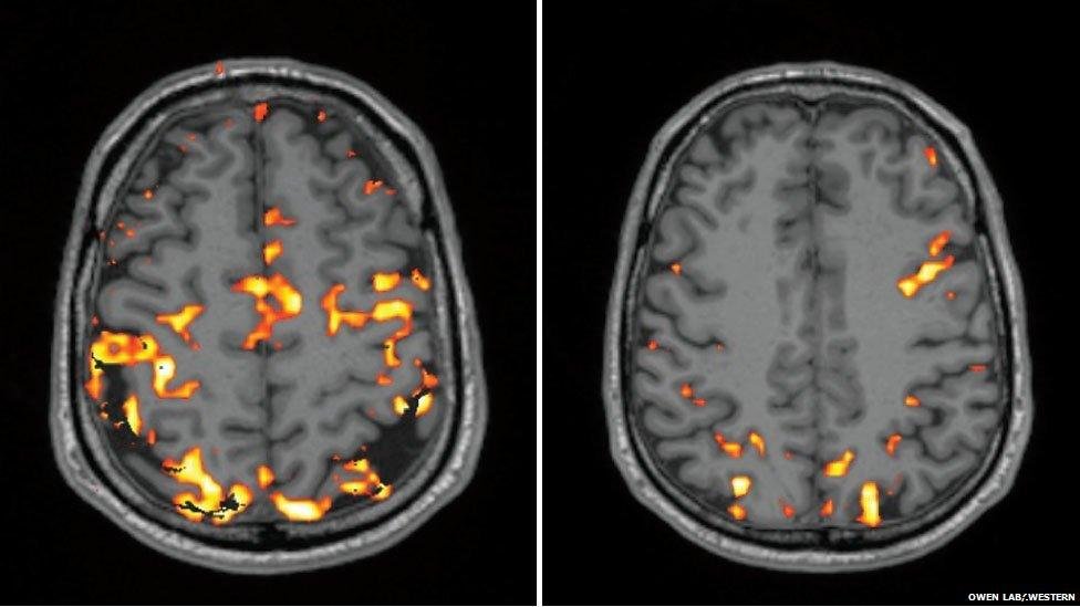 Poor sleep can eat away at your brain